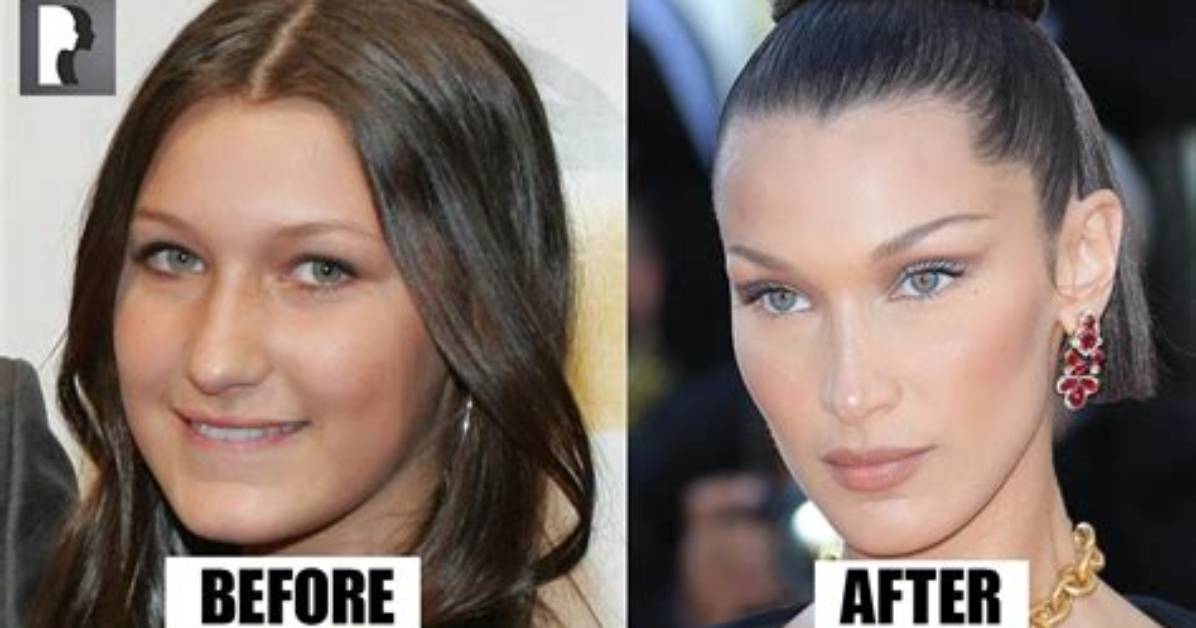 Bella Hadid Admits to the Surgery She Had at 14, Including a Nose Job