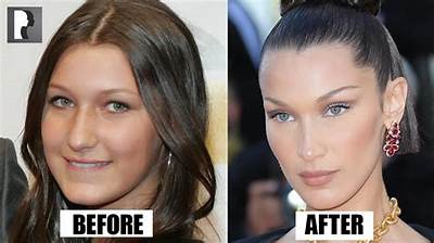 Bella Hadid Admits to the Surgery She Had at 14, Including a Nose Job