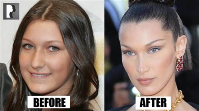 Bella Hadid Admits to the Surgery She Had at 14, Including a Nose Job