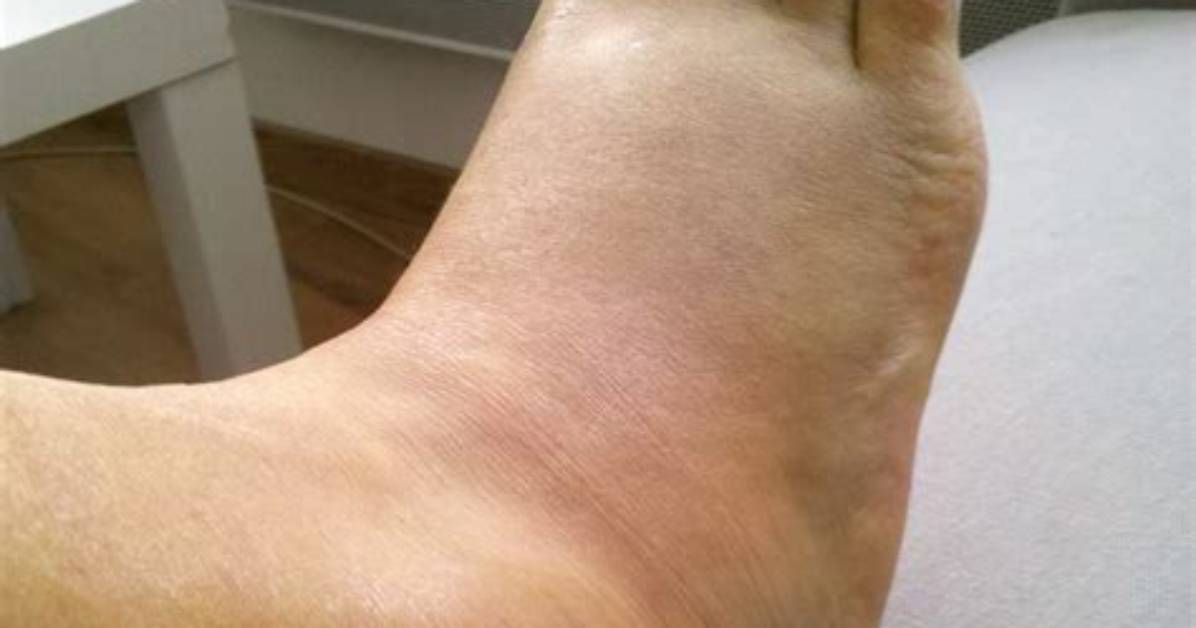 Comment Se Faire Une Entorse Avec Une Pomme De Terre?