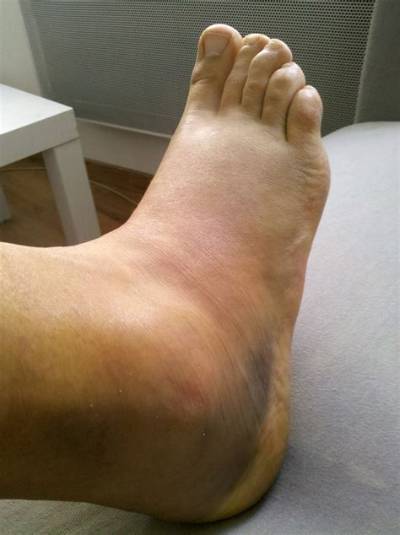 Comment Se Faire Une Entorse Avec Une Pomme De Terre?