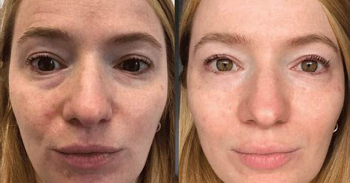 I Tried Prp for Dark Under-Eye Circles—Here Are My Thoughts