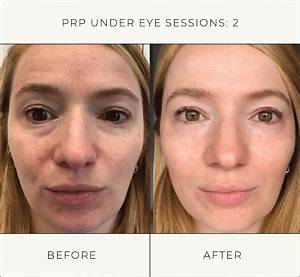 I Tried Prp for Dark Under-Eye Circles—Here Are My Thoughts