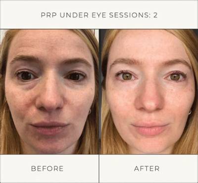 I Tried Prp for Dark Under-Eye Circles—Here Are My Thoughts