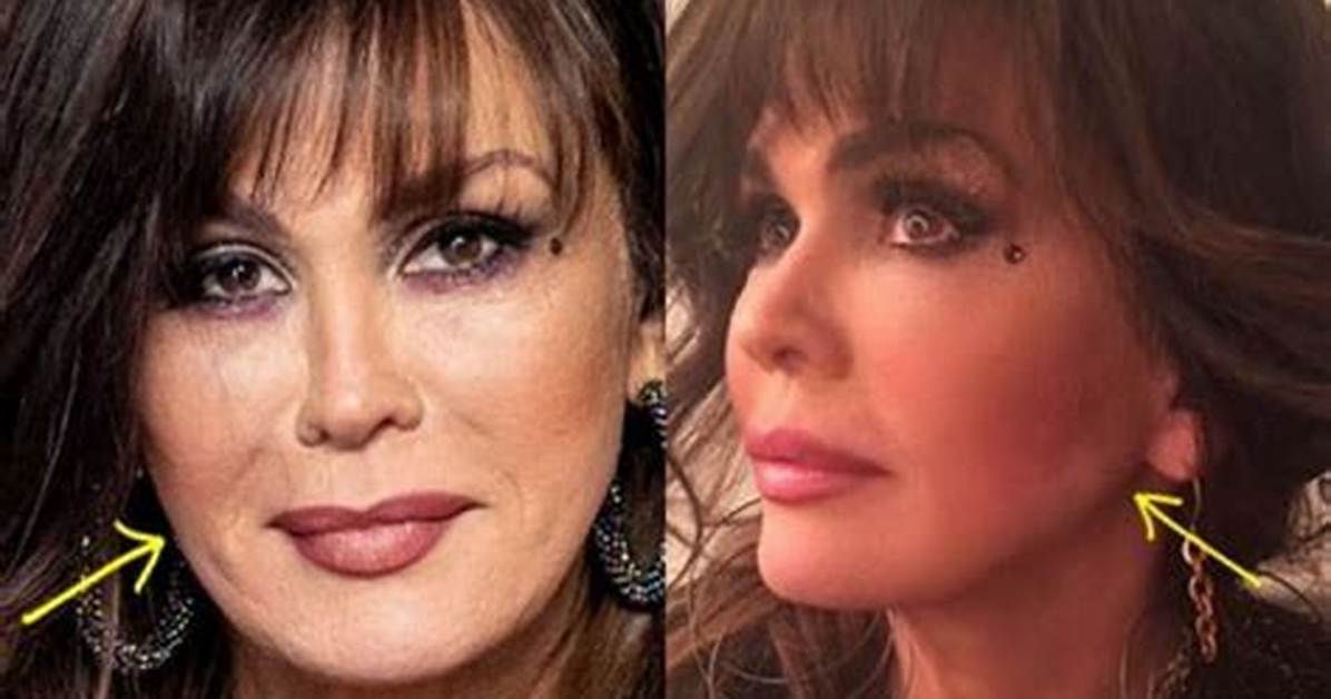 Marie Osmond Without Makeup Look: Plastic Surgery Before and After