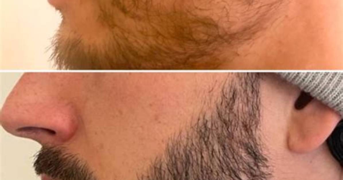 Pourquoi Certains Hommes N’ont Pas De Pomme D’adam?