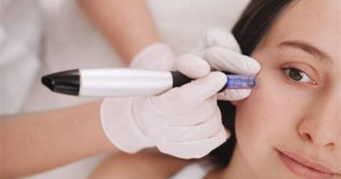 What I Wish I Knew About Microneedling Before Trying It