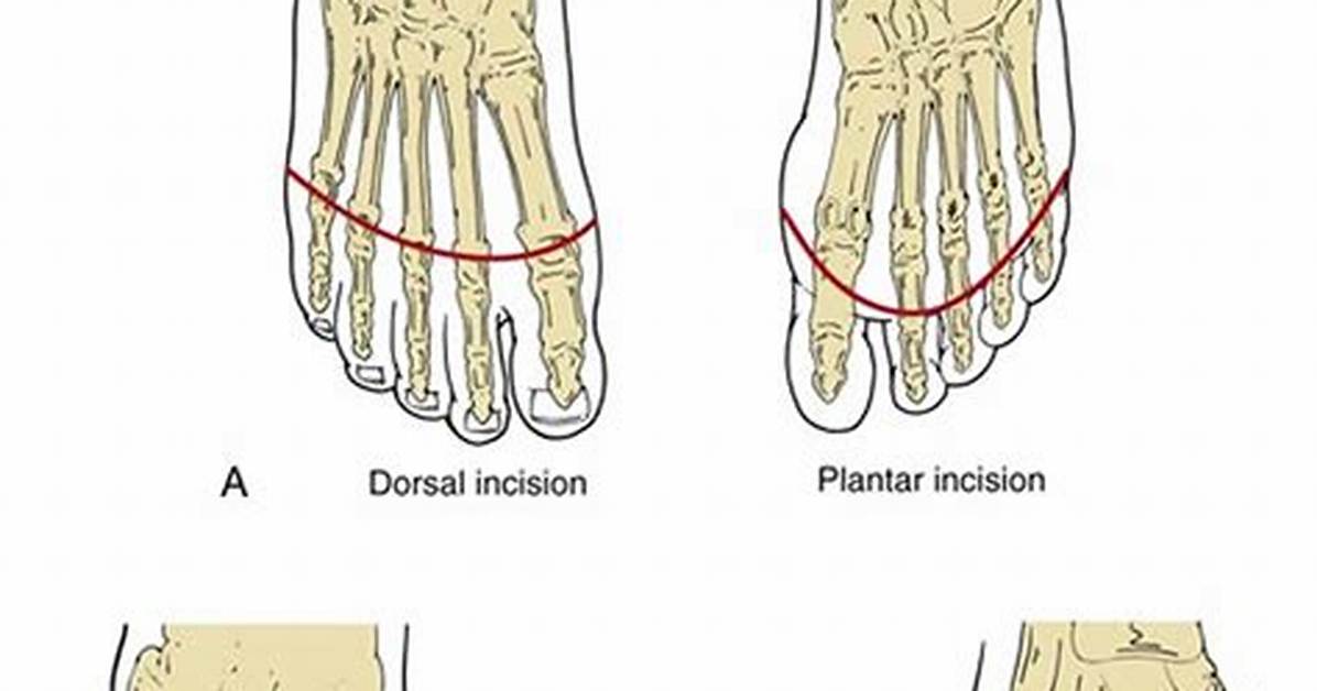 What Is a 5Th Ray Amputation?