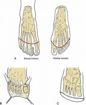 What Is a 5Th Ray Amputation?