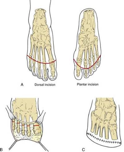 What Is a 5Th Ray Amputation?