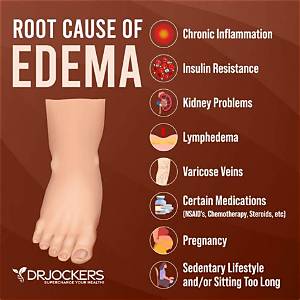 What Is the Main Causes of Edema?