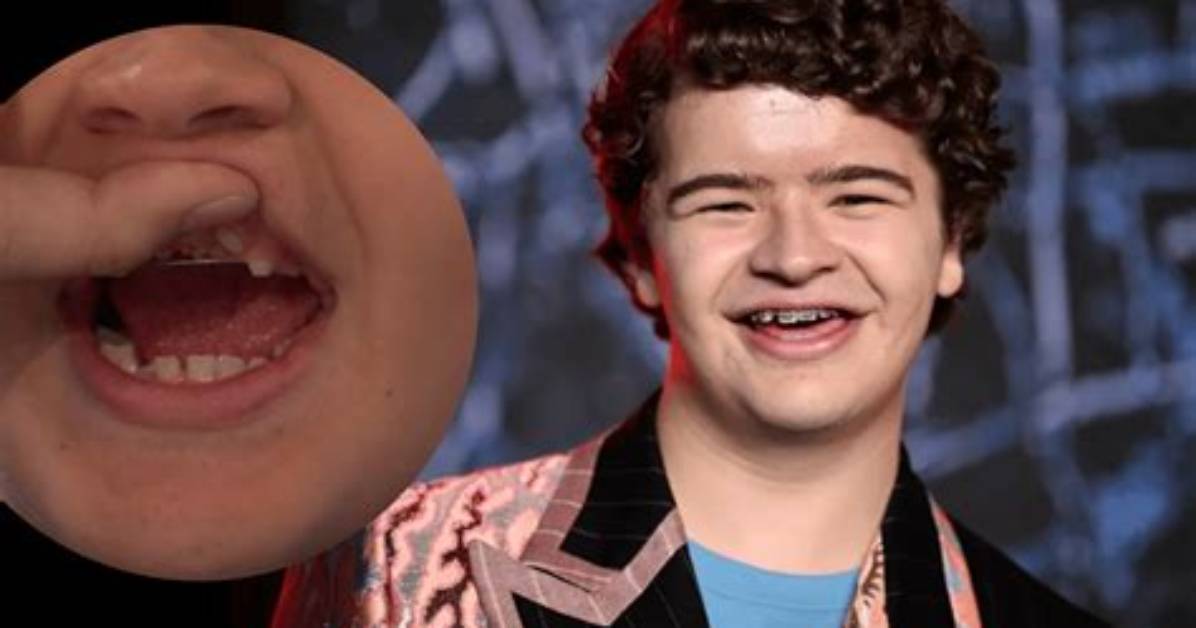 What Is Wrong with Gaten Matarazzo Teeth? More on Cleidocranial Dysplasia Surgery