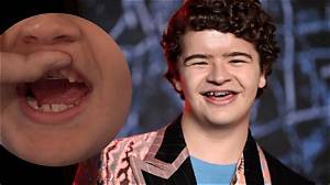 What Is Wrong with Gaten Matarazzo Teeth? More on Cleidocranial Dysplasia Surgery