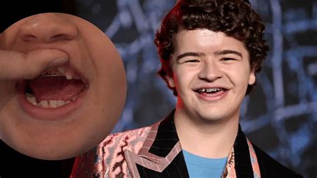 What Is Wrong with Gaten Matarazzo Teeth? More on Cleidocranial Dysplasia Surgery