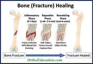 Why Do Bone Injuries Heal Much More Rapidly Than Injuries to Cartilage?