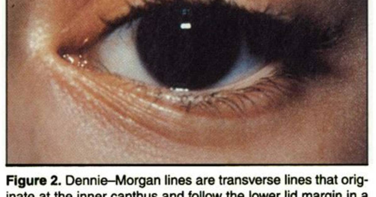 Why Do I Have Dennie Morgan Lines?